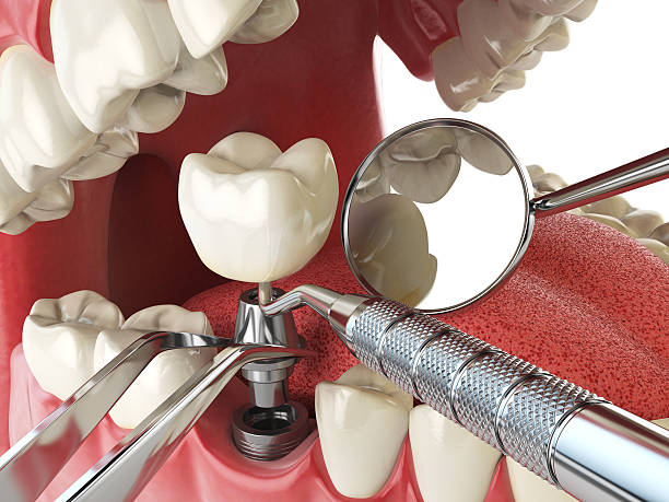 Best Emergency Treatment for Dental Infections or Abscesses in Rocky Top, TN